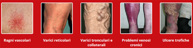 conseguenze vene varicose