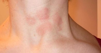 Psoriasi: ci si può esporre ai raggi solari? psoriasi sul collo