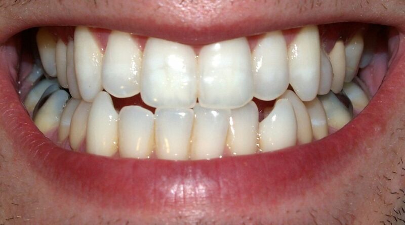 pulizia dei denti